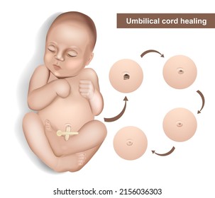 Umbilical cord care in newborns. Newborn umbilical cord stump falling off cycle. Dried stump of an umbilical cord of a newborn baby. Umbilical cord healing