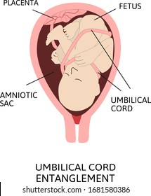 Umbilical cord entanglement. vector illustration of entanglement of umbilical cord around the fetus. placenta, amniotic sac and fetus are in the womb. 