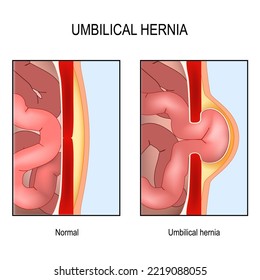 Umbilical hernia. Cross section of abdomen with small intestine, muscle and abdominal wall. Normal human's belly and muscle rupture with hernial sac. Vector poster