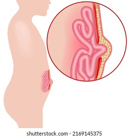 Umbilical hernia. divergence of the abdominal muscles. Internal organs protruding. Medical poster. Vector illustration