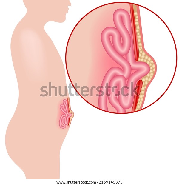 Umbilical
hernia. divergence of the abdominal muscles. Internal organs
protruding. Medical poster. Vector
illustration