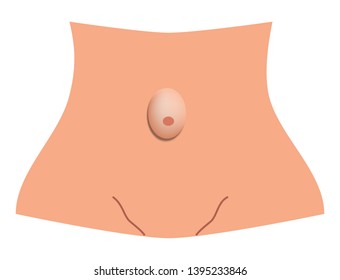 Umbilical hernia. intestinal hernia. Infographics. Vector illustration on isolated background.