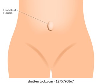 umbilical hernia / intestine / human anatomy / belly vector