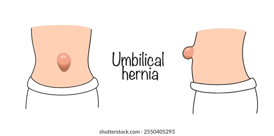 Hernia umbilical. Una protrusión que, bajo ciertas condiciones, se forma en el espacio intermuscular debido a la divergencia de los músculos abdominales. Hernia umbilical dibujada. Vistas frontales y laterales. Vector.