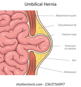 Umbilical hernia structure scheme diagram schematic vector illustration. Medical science educational illustration