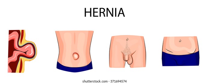 Umbilical And Inguinal Hernia