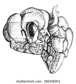 Under Surface Of Liver Showing Results Of Congenital Syphilis, Vintage Engraved Illustration.
