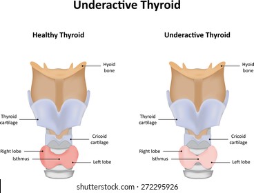 4-under-active-thyroid-gland-shutterstock
