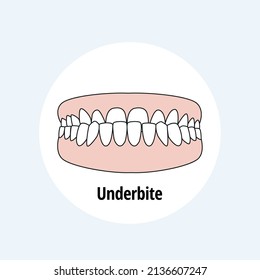 Underbite. Dental problem vector illustration. Dental care concept.