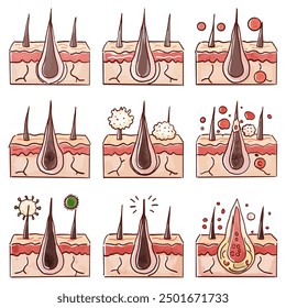 Understanding Acne: Skin and Pore Analysis