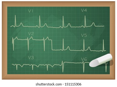 Understanding Heart ECG