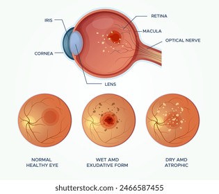 Understanding Macular Degeneration Healthy Eyes vs Wet and DRY AMD - Stock Illustration as EPS 10 File