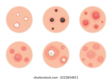 Understanding Type of Acne A Comprehensive Visual Guide for Everyone