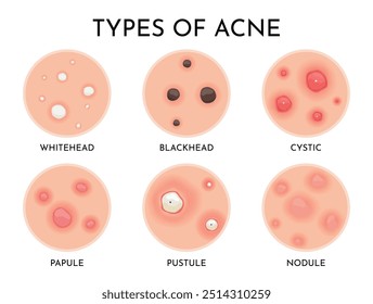 Understanding the Various Types of Acne A Comprehensive Visual Guide for Everyone