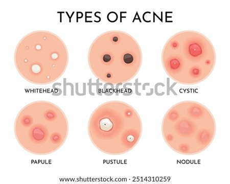 Understanding the Various Types of Acne A Comprehensive Visual Guide for Everyone