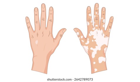 Understanding Vitiligo A Comprehensive Guide to Causes Symptoms Diagnosis and Treatment Options Available