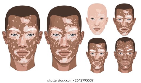 Entendendo o vitiligo A condição da pele e seu impacto psicológico nas pessoas afetadas