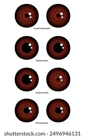 Unequal, Constricted, Dilated and normal pupils eye diseases ophthalmology