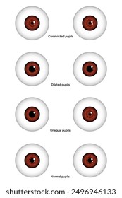 Unequal, Constricted, Dilated and normal pupils eye diseases ophthalmology