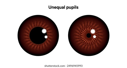 Unequal pupils eye diseases ophthalmology