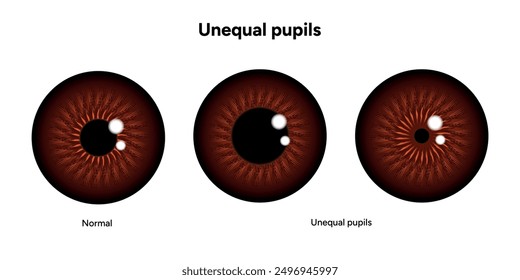 Unequal pupils eye diseases ophthalmology