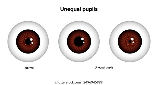 Unequal pupils eye diseases ophthalmology