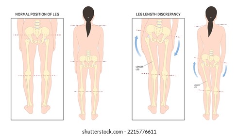 Unequal short leg length discrepancy and tilt curvature body misaligned poor postural stand High pelvis femur Limb bone tilting shoulder or toe walking ankle syndrome