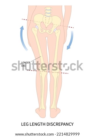Unequal short leg length discrepancy and tilt curvature body misaligned poor postural stand High pelvis femur Limb bone tilting shoulder or toe walking ankle syndrome [[stock_photo]] © 