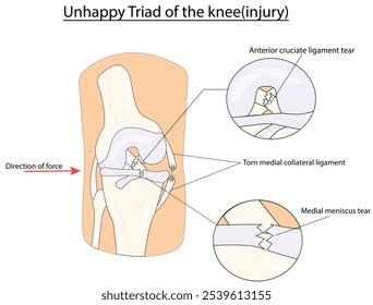 ilustração do vetor da tríade infeliz do joelho (lesão)