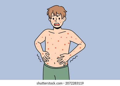 Unhealthy boy with red spots on body suffer from measles or rubella. Anxious unwell man struggle with rash fever, have severe symptoms. Healthcare concept. Flat vector illustration. 