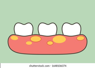 unhealthy teeth because gingivitis or gum disease with abscess in gum - dental cartoon vector flat style cute character for design