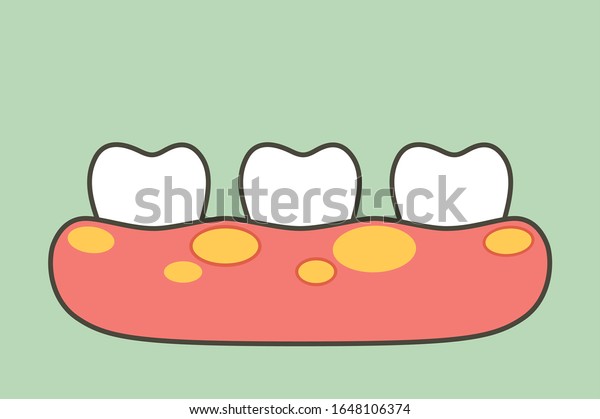歯肉炎や歯茎の膿瘍が原因で歯が不健康になる歯 歯のカートーンベクターのフラットなスタイルのデザインのかわいいキャラクター のベクター画像素材 ロイヤリティフリー