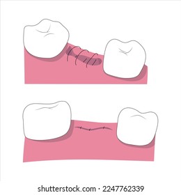 Unhealthy tooth extraction process medical illustration. Healing of the wound.