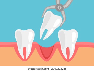 Unhealthy tooth removal process concept vector illustration. Dental extraction forceps and tooth in flat design.