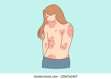 Unhealthy woman showing red rash on back suffer from dermatitis. Unwell girl struggle with dermatology disease. Healthcare concept. Vector illustration. 