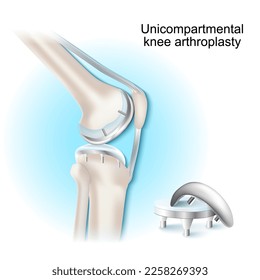 Artroplastía unicompartmental de rodilla. procedimiento quirúrgico para el tratamiento o el alivio de la artritis, después de daño articular. implante uni de rodilla. Sustitución parcial de la rodilla sobre fondo azul y blanco. vista lateral