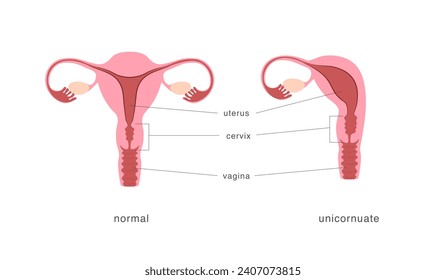 Tabla de comparación unicornua y normal de útero saludable. Malformación congénita del sistema reproductivo femenino.