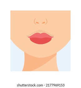 Unwanted Facial Hair. Female Mustache above the Upper Lip. Front view. Hormonal Disbalance. Color Cartoon style. White background. Vector illustration for Medical and Beauty Design.