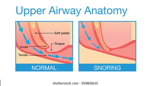 Upper Airway Human Anatomy In  Normal Sleeping And Have Snoring.