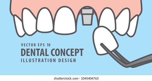 Upper Banner Single implant tooth illustration vector on blue background. Dental concept.