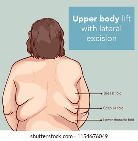 UPPER BODY LİFT WİTH LATERAL EXCİSİON 2