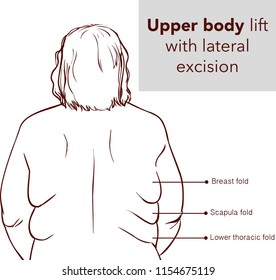 UPPER BODY LİFT WİTH LATERAL EXCİSİON2