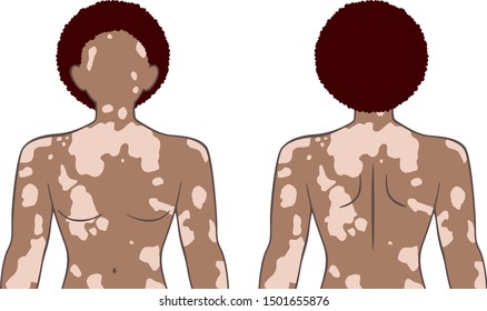 Upper body of the man who has symptom of the skin ;  vitiligo.