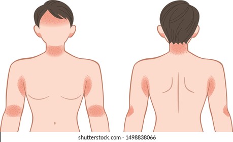 Upper Body Of The Woman, Suffers From A Skin Disease;  Rash, Heat Rash.