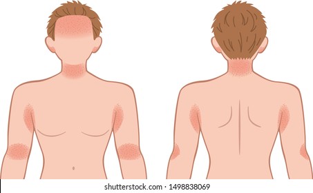 Upper body of the woman, suffers from a skin disease;  rash, heat rash.