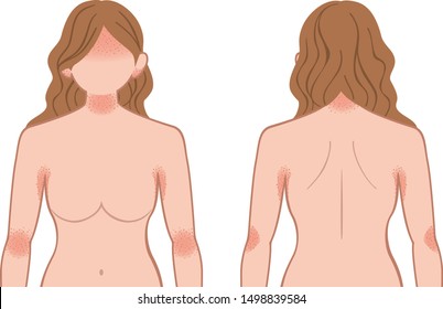 Upper Body Of The Woman, Suffers From A Skin Disease;  Rash, Heat Rash.