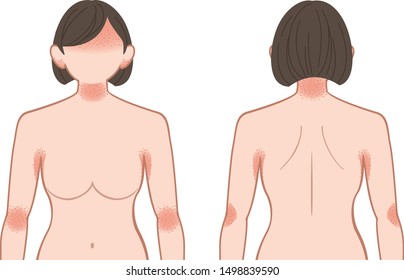 Upper body of the woman, suffers from a skin disease;  rash, heat rash.