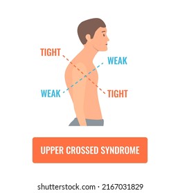 Upper crossed syndrome medical diagram. Crooked man with muscle strength imbalance. Weak and overactive muscles therapy. Incorrect spine curvature caused by bad posture. Vector illustration.