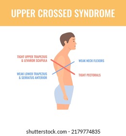 Upper crossed syndrome medical diagram. Crooked man with muscle strength imbalance. Weak and overactive muscles therapy. Incorrect spine curvature caused by bad posture. Vector illustration.