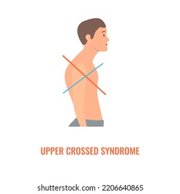 Upper Crossed Syndrome Medical Diagram. Crooked Man With Muscle Strength Imbalance. Weak And Overactive Muscles Therapy. Incorrect Spine Curvature Caused By Bad Posture. Vector Illustration.